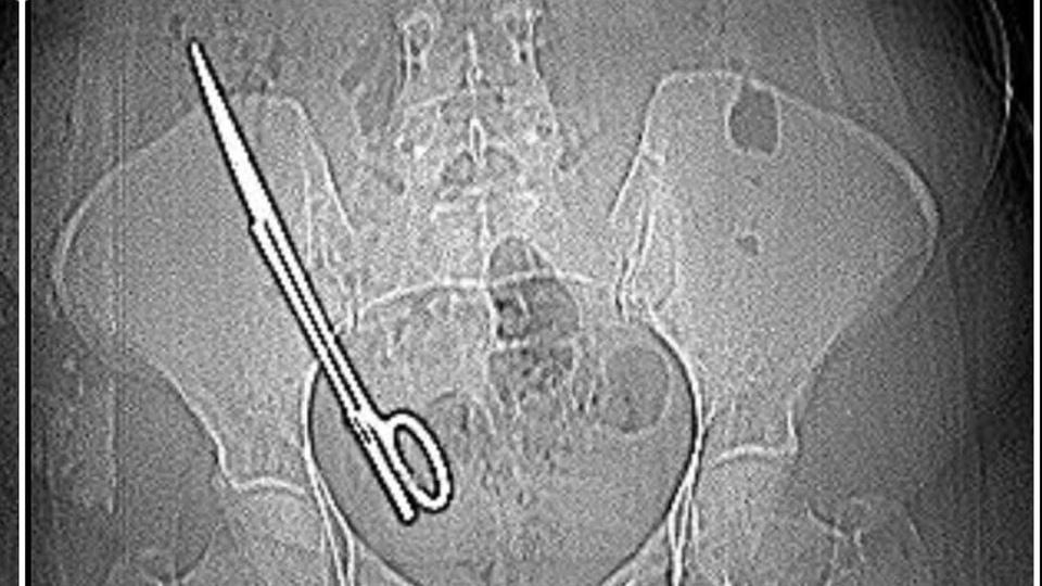 Ameliyatta karnında unutulan makas, 7 yıl sonra baş ağrısıyla ortaya çıktı