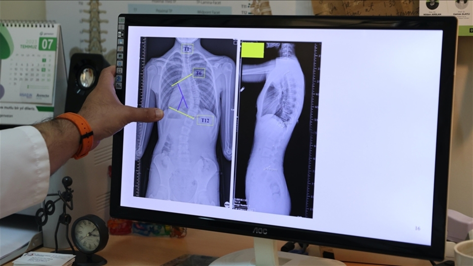 Skolyozun yüzde 80'i ergenlikte ortaya çıkıyor!