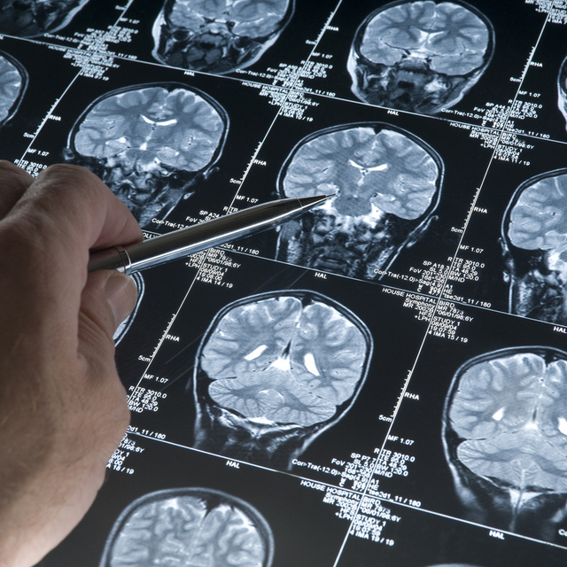  Beyin sisini yenmenin yolları neler?