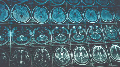 Yapay zeka inme tedavisinde çığır açacak
