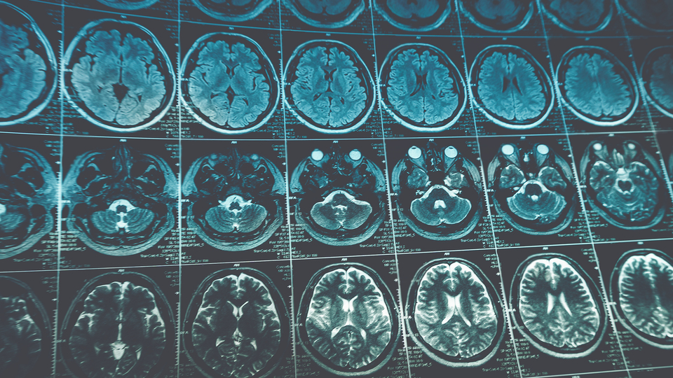 Yapay zeka inme tedavisinde çığır açacak