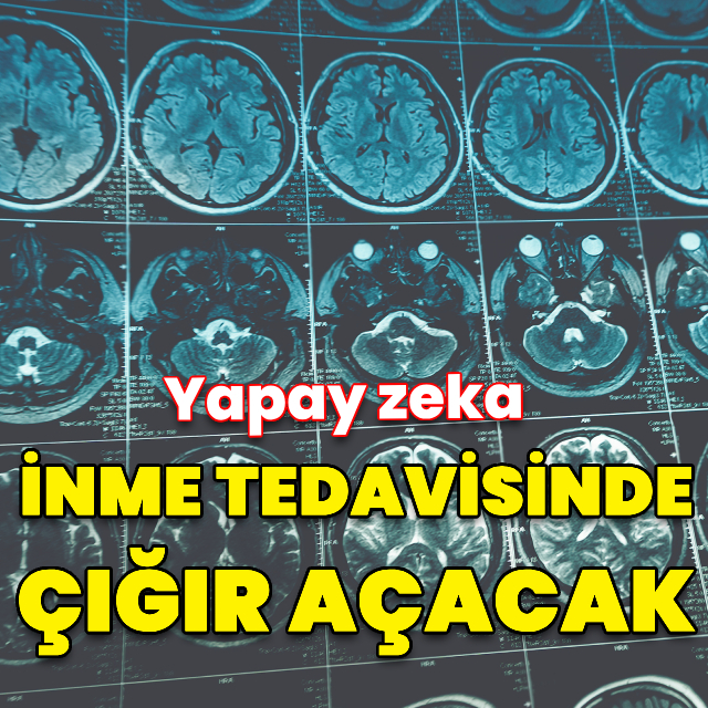 Yapay zeka inme tedavisinde çığır açacak