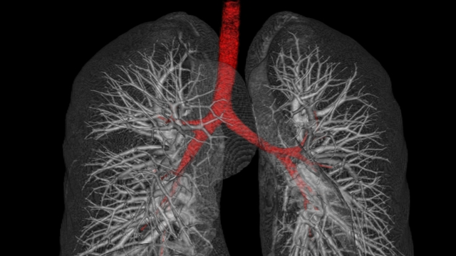 Mikroplastik tehdidi! Kolon ve akciğer kanseri ile üreme rahatsızlıklarına yol açabilir