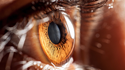 Keratokonus tedavi edilmezse 40'lı yaşlara kadar ilerliyor