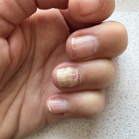 Tırnak mantarı hakkında bilinmesi gerekenler