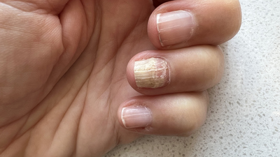 Tırnak mantarı hakkında bilinmesi gerekenler