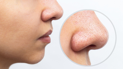 Siyah nokta temizliği nasıl yapılır?