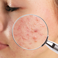 Sivilce izlerinizden nasıl kurtuluruz?