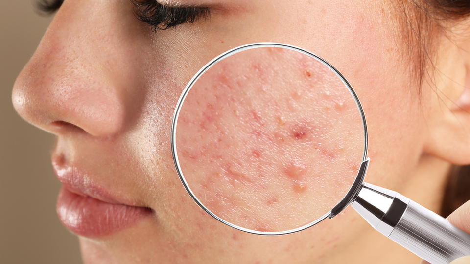 Sivilce izlerinizden nasıl kurtuluruz?