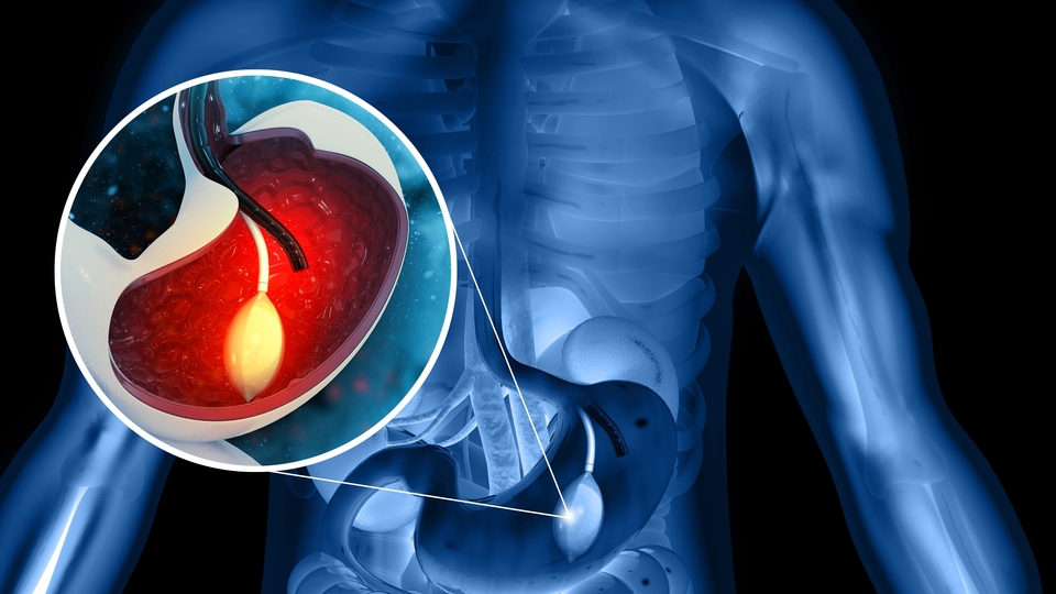 Yutulabilir mide balonları yasaklandı