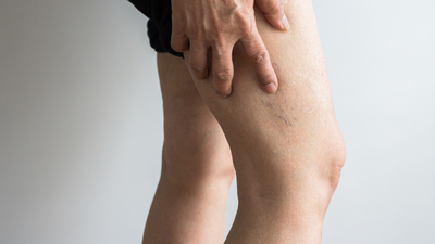 Vücutta varis olup olmadığı nasıl anlaşılır?