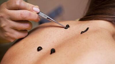 Sülükten sonra hayvansal gıda yenir mi