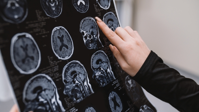 Alzheimer ve Parkinson tedavisinde umut veren gelişme