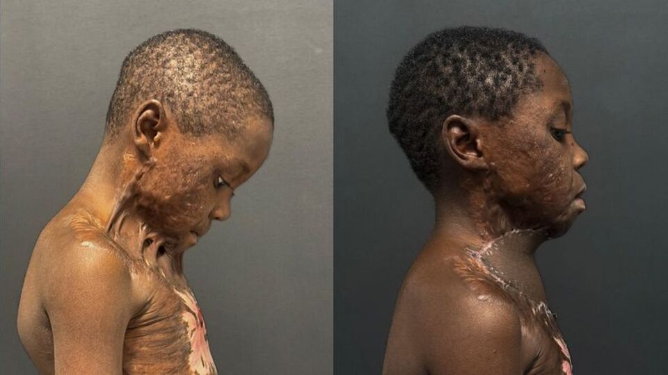 Oyun oynarken yandı! 7 saatlik operasyonla sağlığına kavuştu