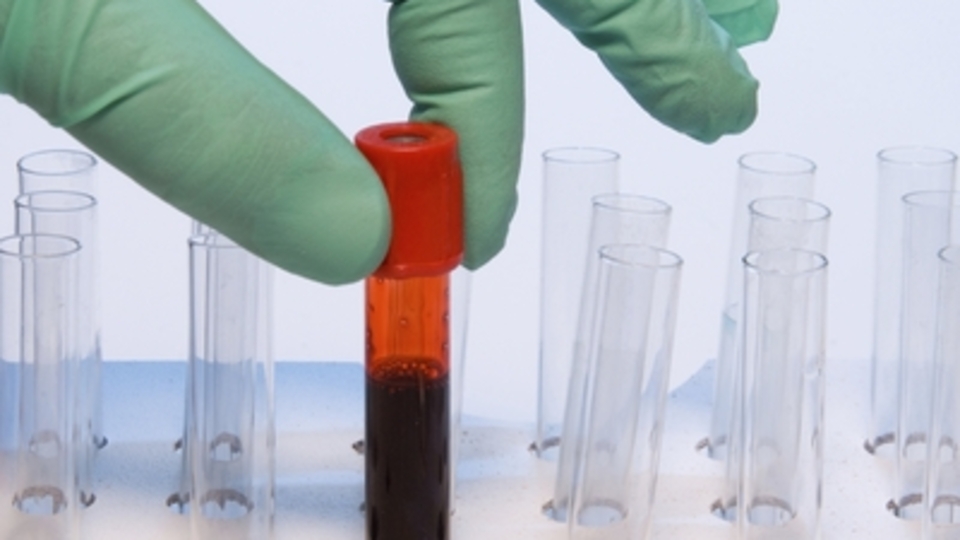 Kan Tahlilinden Önce Yemek Yenir Mi?