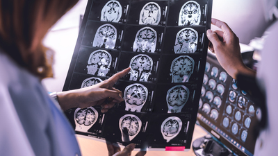 Uykunun REM evresine geçişte zorlanmak Alzheimer belirtisi olabilir