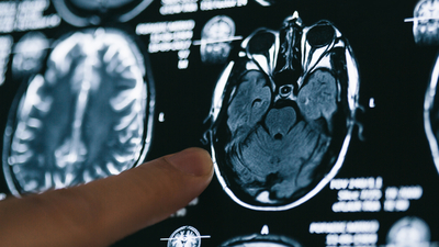 Beyindeki mikroplastik oranı hızla artıyor