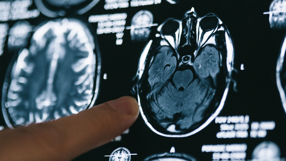 Beyindeki mikroplastik oranı hızla artıyor