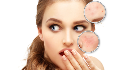 Her cilt lekesinin tedavisi aynı değil!