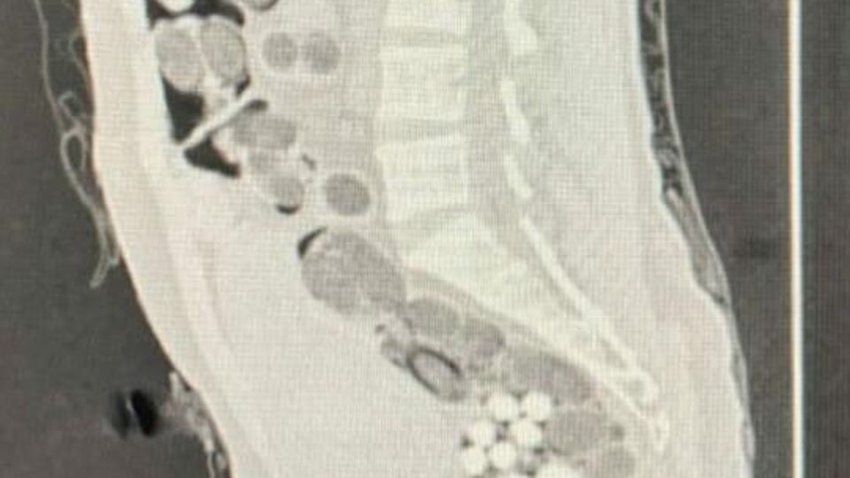 Yolcunun midesinden paket paket uyuşturucu çıktı!