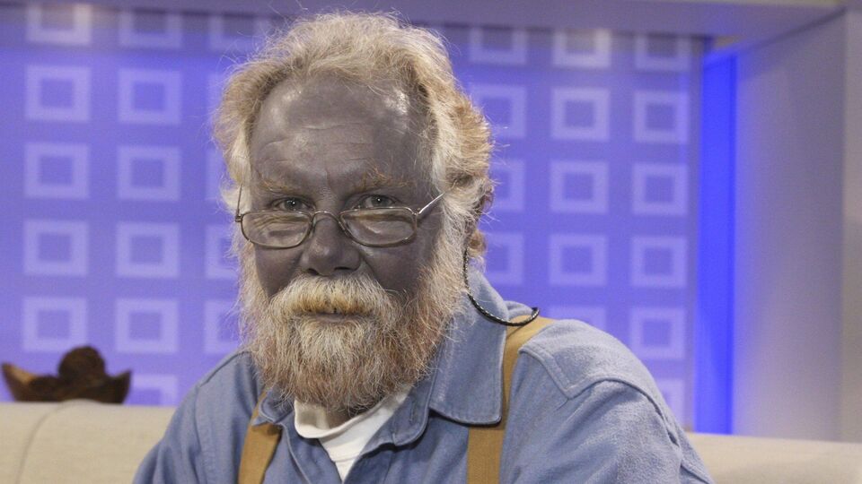 Bu hastalık insanları maviye çeviriyor!