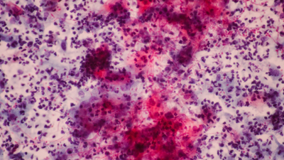 Kanserli çocuk sayısı her geçen yıl artıyor