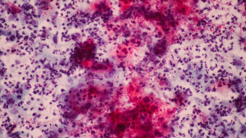 Kanserli çocuk sayısı her geçen yıl artıyor