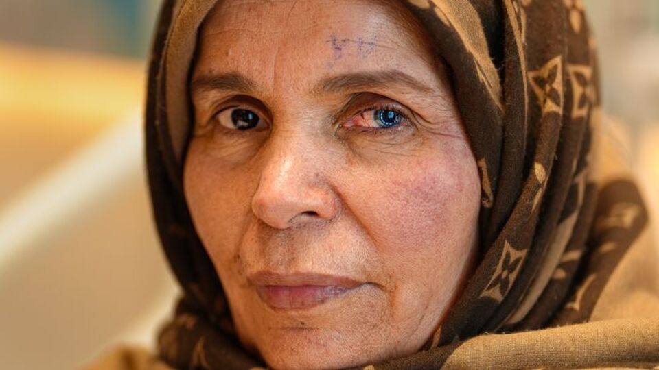 Kornea nakliyle iki farklı göz rengine sahip oldu