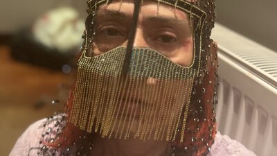 Kimyasal yanıkları maskeyle kapatıyor