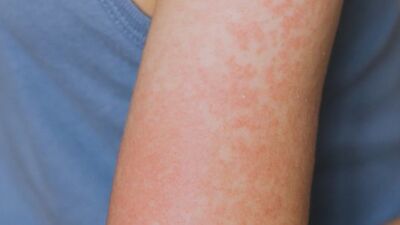 Teksas'ta 48 kızamık vakası bildirildi