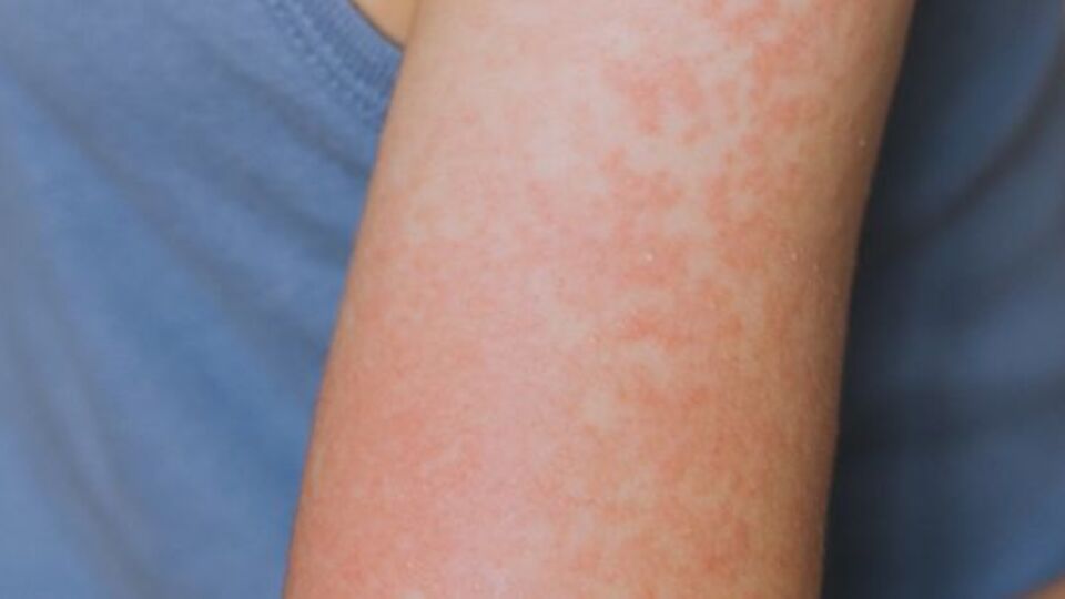 Teksas'ta 48 kızamık vakası bildirildi