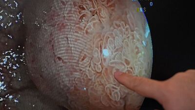 Diz ve kalça ağrısıyla gitti, bağırsak kanseri olduğunu öğrendi