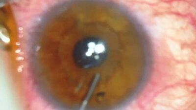 7 yıl gözünde metal parçasıyla yaşadı