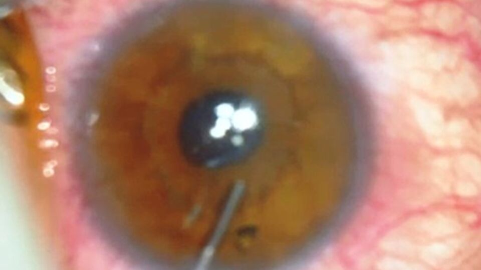 7 yıl gözünde metal parçasıyla yaşadı
