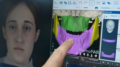 Tek yumurta ikizlerine, 3 boyutlu modellemeyle çene ameliyatı