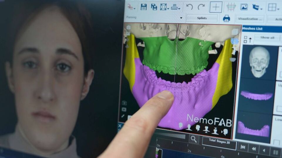 Tek yumurta ikizlerine, 3 boyutlu modellemeyle çene ameliyatı