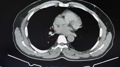 1.5 yıl astım tedavisi görmüştü! Meğer silikon yutmuş