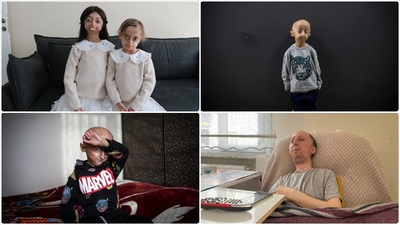 Nadir hastalıklar 400 milyon kişiyi etkiliyor
