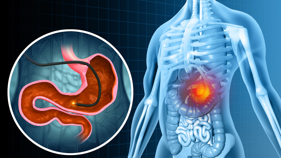 Her üç kişiden birinde var! Mide kanseri riskini artırıyor!