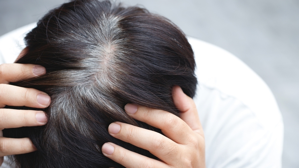 Erken yaşta saçlar neden beyazlar?