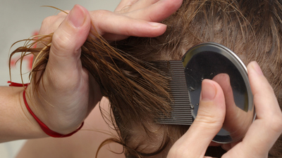 Bu belirtilere dikkat! Saç biti olabilir!