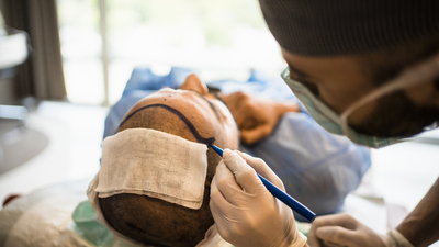 Saç ekimi kimler için uygun? İşte aranan kriterler!