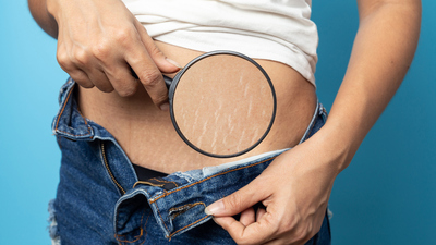 Çatlak izlerinden nasıl kurtulunur?