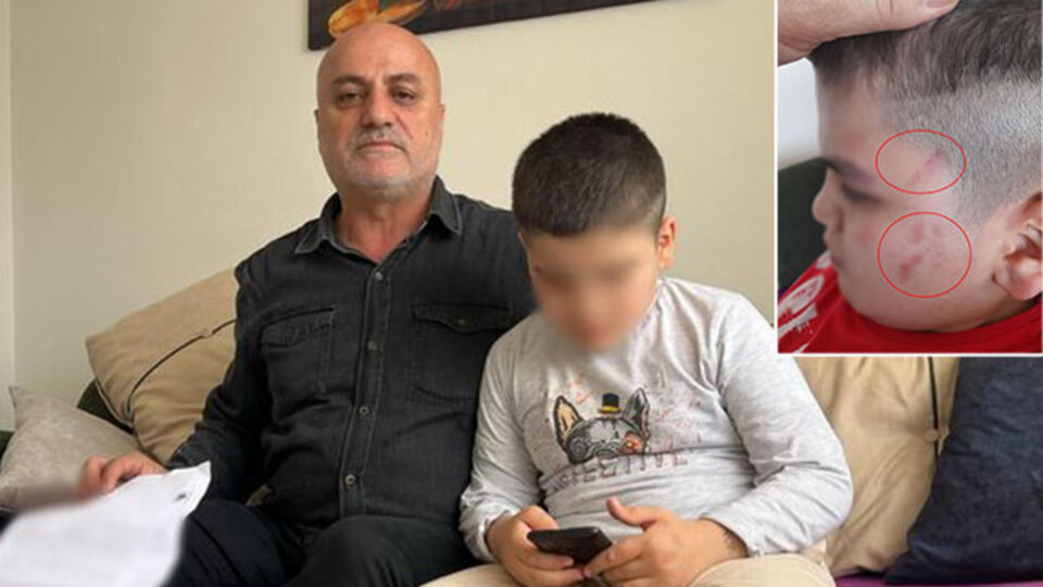 Öğretmen açığa alındı! Otizmli çocukta 54 morluk!