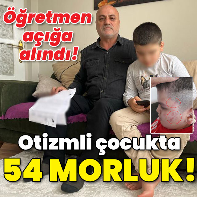 Öğretmen açığa alındı! Otizmli çocukta 54 morluk!