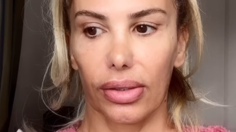 "Botoks zehirlenmesi yaşadım"