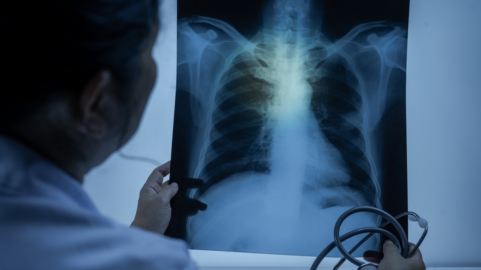 Türkiye'de tüberküloz oranı düşüşte