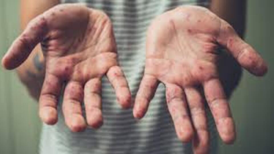 ABD'nin Kansas eyaletinde 23 kızamık vakası bildirildi