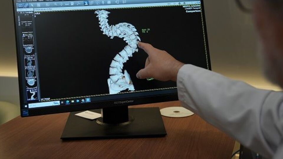 Erken teşhis edilmeyen skolyozun tedavisi zorlaşıyor