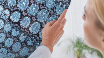 Beyin kanaması geçirdi! Kafatası parçasını midesinde taşıdı